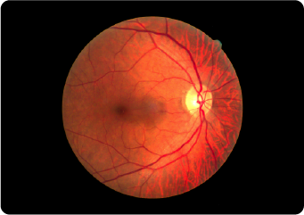 眼底検査（糖尿病・高血圧等）